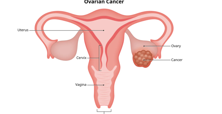 Ovarian Cancer