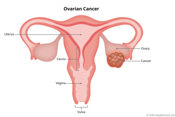 Ovarian Cancer